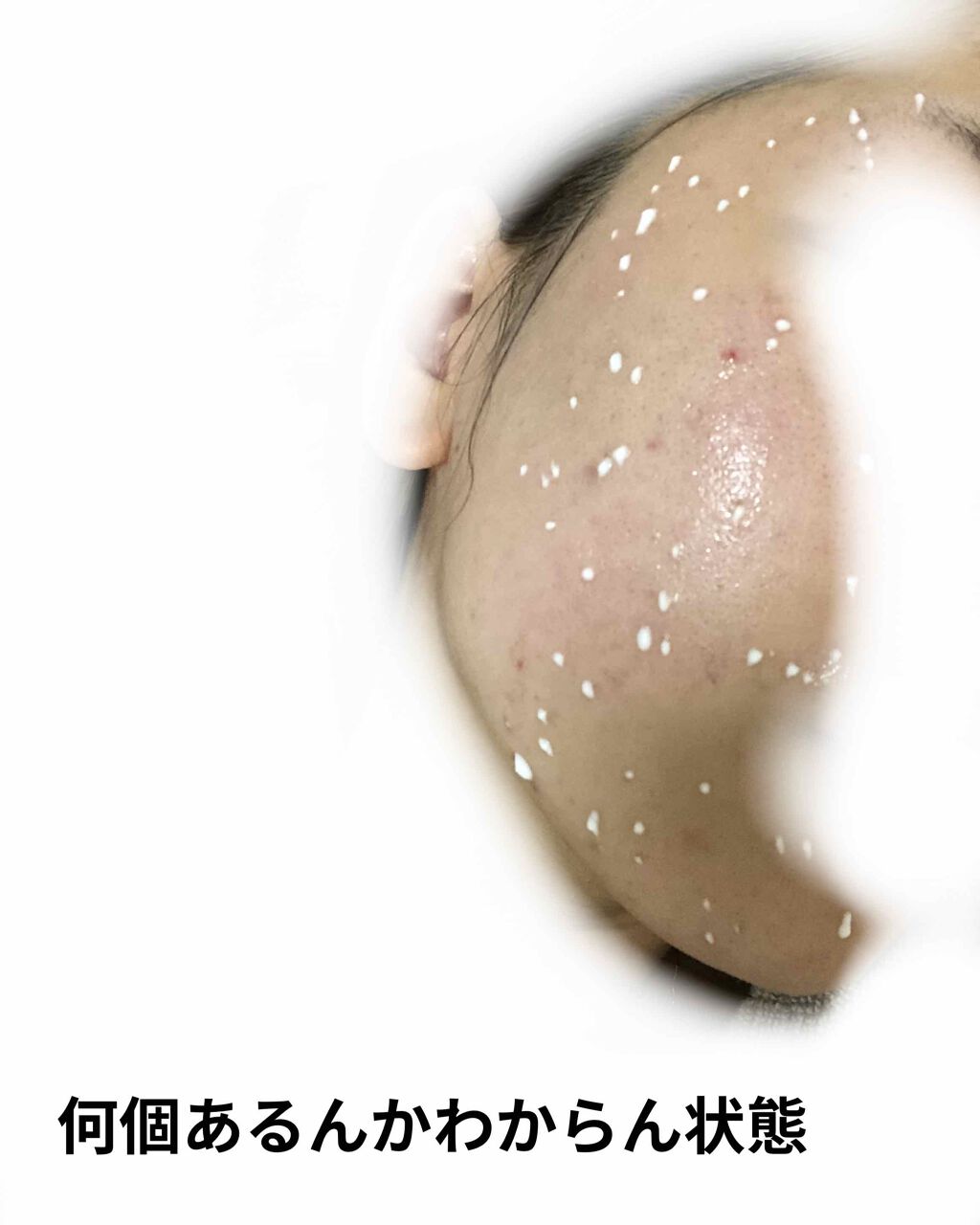 ペアアクネクリームW(医薬品)/ペア/その他を使ったクチコミ（3枚目）