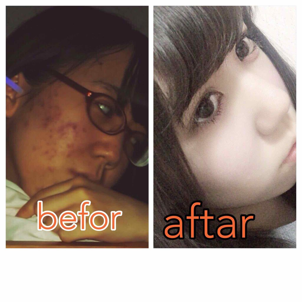 テラ・コートリル 軟膏(医薬品)/ジョンソン・エンド・ジョンソン/その他を使ったクチコミ(2枚目)