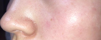 赫音 on LIPS 「1.2枚目は8/25(白ニキビかました)3.4枚目は8/17少..」(5枚目)