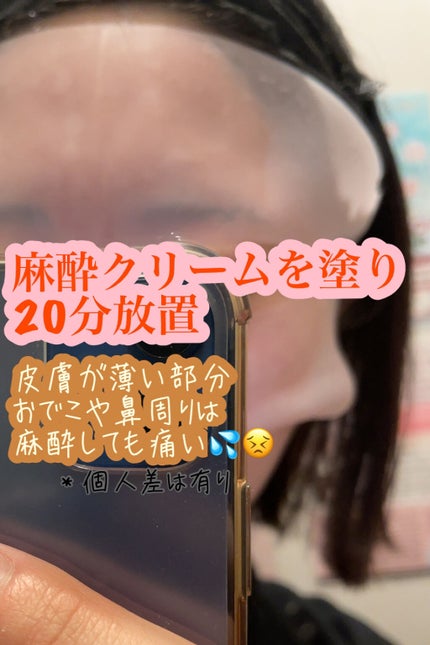 Honk❁ on LIPS 「20歳前半の女がニキビに悩まされすぎてダーマペン受けてみた。P..」(2枚目)