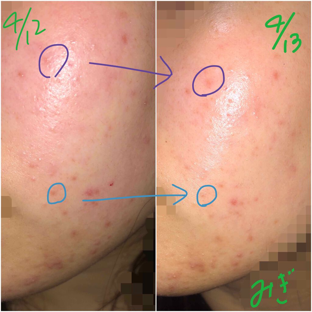 薬用 しみ 集中対策 美容液/メラノCC/美容液を使ったクチコミ（3枚目）