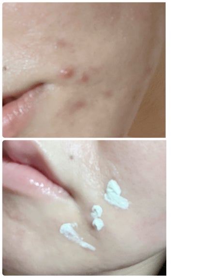 ミラクルアクネクリアスポットトリートメント/SOME BY MI/美容液を使ったクチコミ(4枚目)