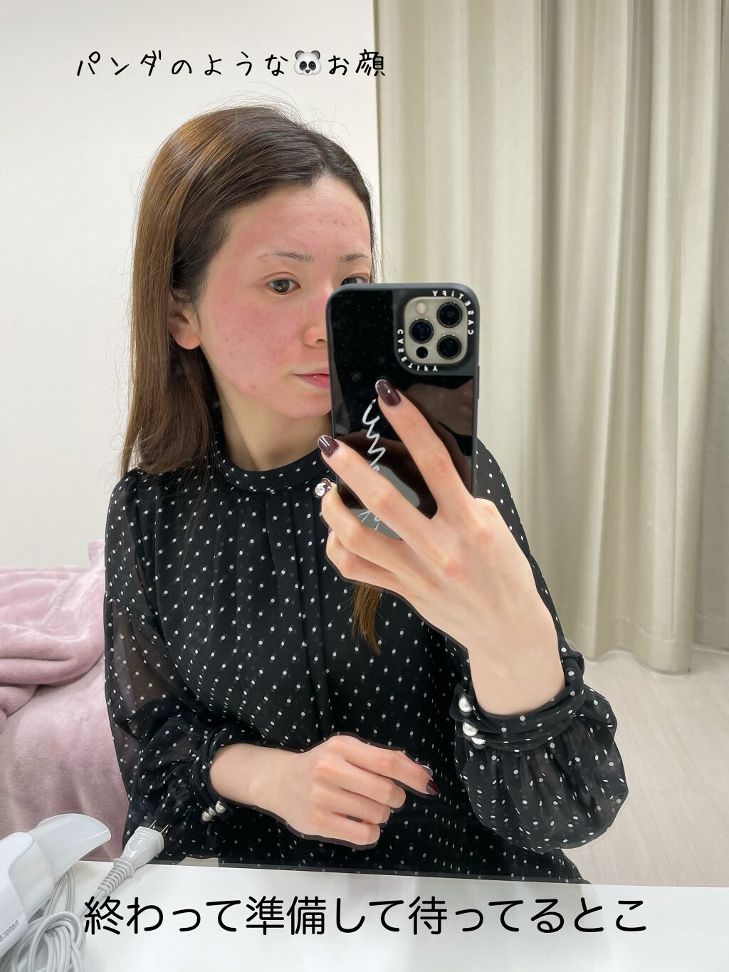 あゆみんっ。 on LIPS 「最近何かと話題な美容医療施術【ダーマペン4】当日終わってまで編..」(4枚目)