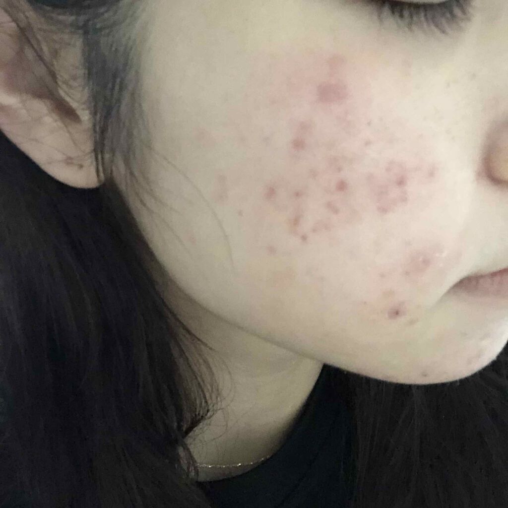 エピデュオゲル/マルホ株式会社/その他を使ったクチコミ（2枚目）