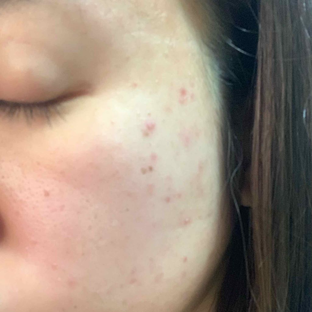 み さ き on LIPS 「⚠️1枚目以降ニキビ肌の写真があるので閲覧注意です…!!⚠️ま..」(2枚目)