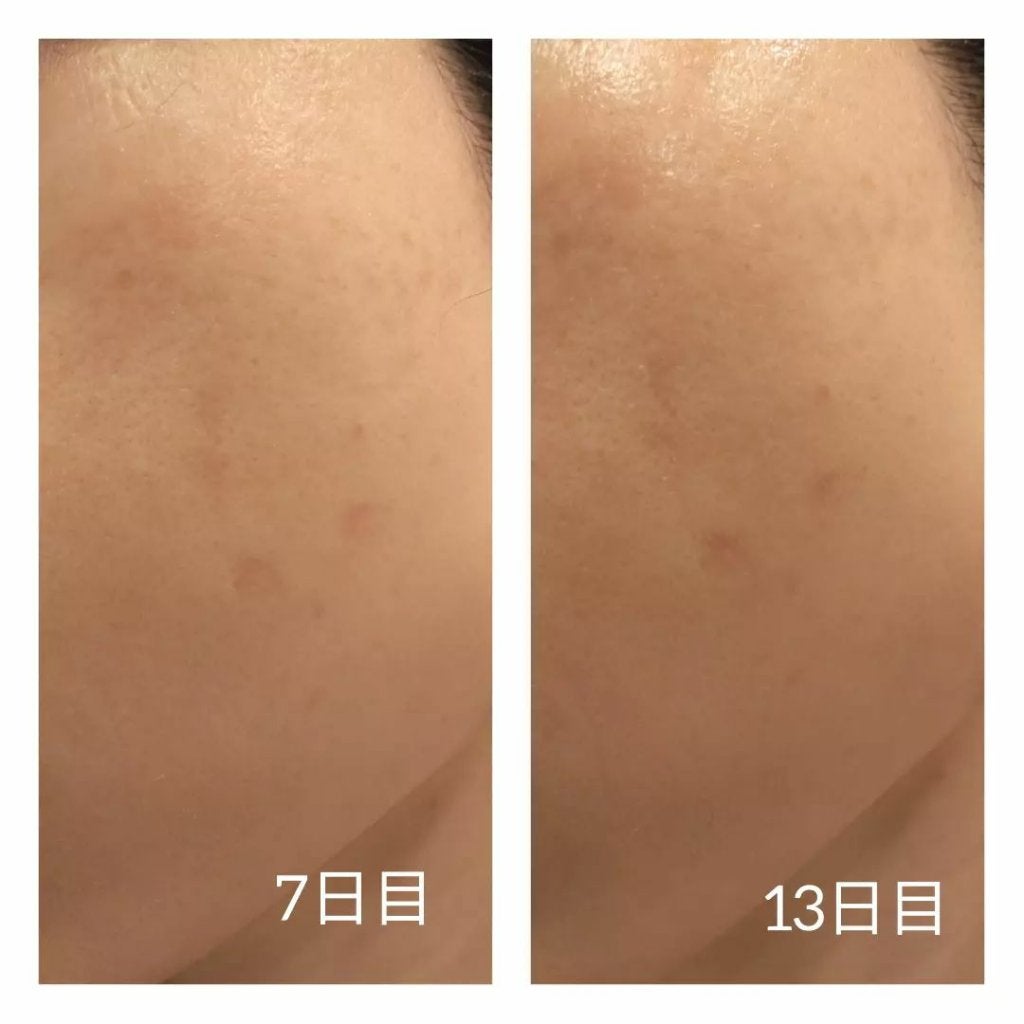 あにゃにゃ♡フォロバ100♡ on LIPS 「5月にしたピコスポット🍅※最後の写真のみ1月した別箇所※今回は..」(5枚目)