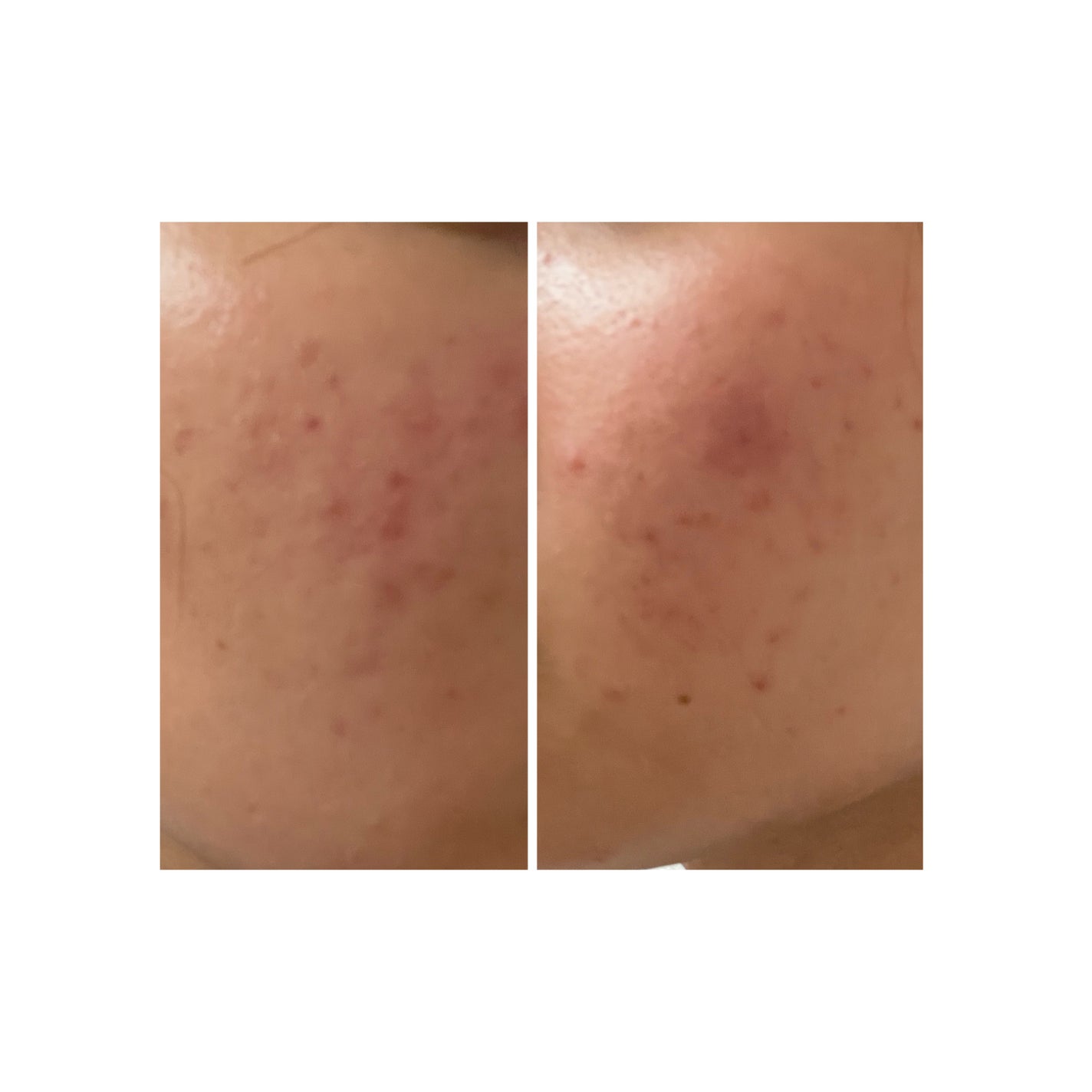 ぽむ on LIPS 「2023.9.13皮膚科に受診 エピデュオとヘパリン処方1枚目..」(2枚目)