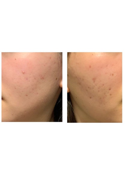 ハトムギ化粧水(ナチュリエ スキンコンディショナー R )/ナチュリエ/化粧水を使ったクチコミ(2枚目)