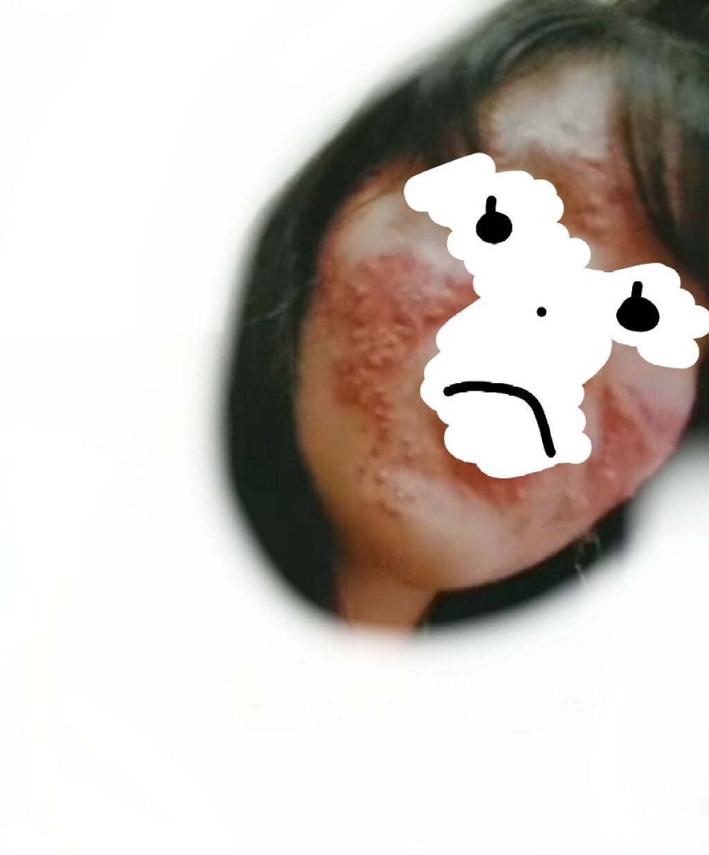nachan on LIPS 「⚠画像閲覧注意です⚠今日は人類で1番肌荒れしたんじゃないかとい..」(2枚目)