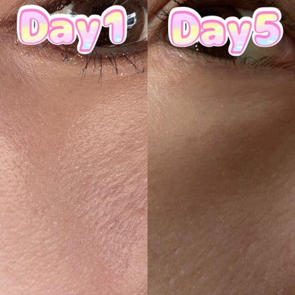 マイルドリードルショット50/VT/美容液を使ったクチコミ(5枚目)