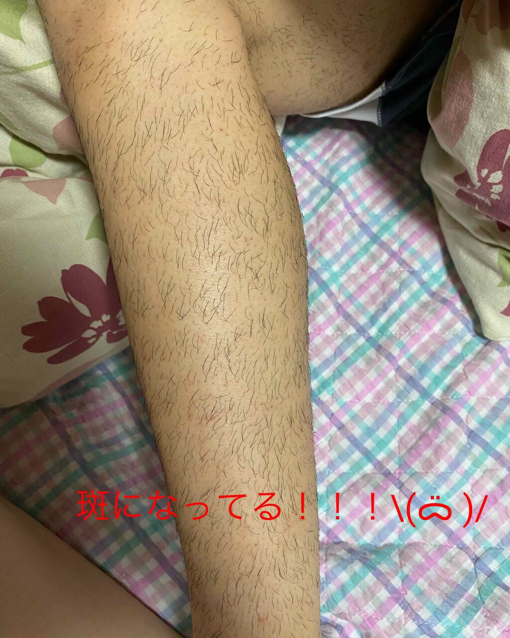 アイスレディ/icelady/家庭用脱毛器を使ったクチコミ（2枚目）