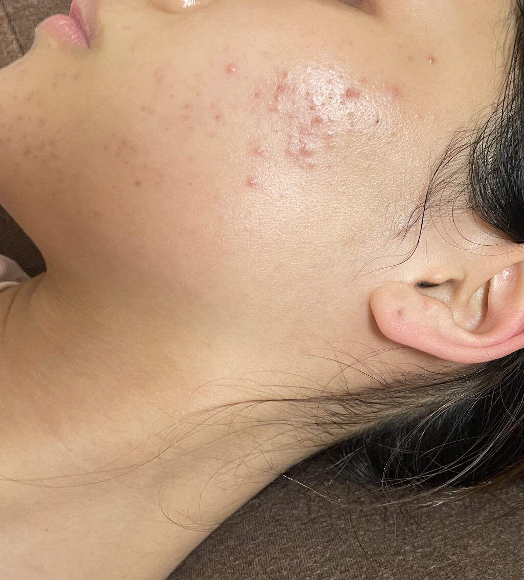 ベピオゲル/マルホ株式会社/その他を使ったクチコミ（2枚目）