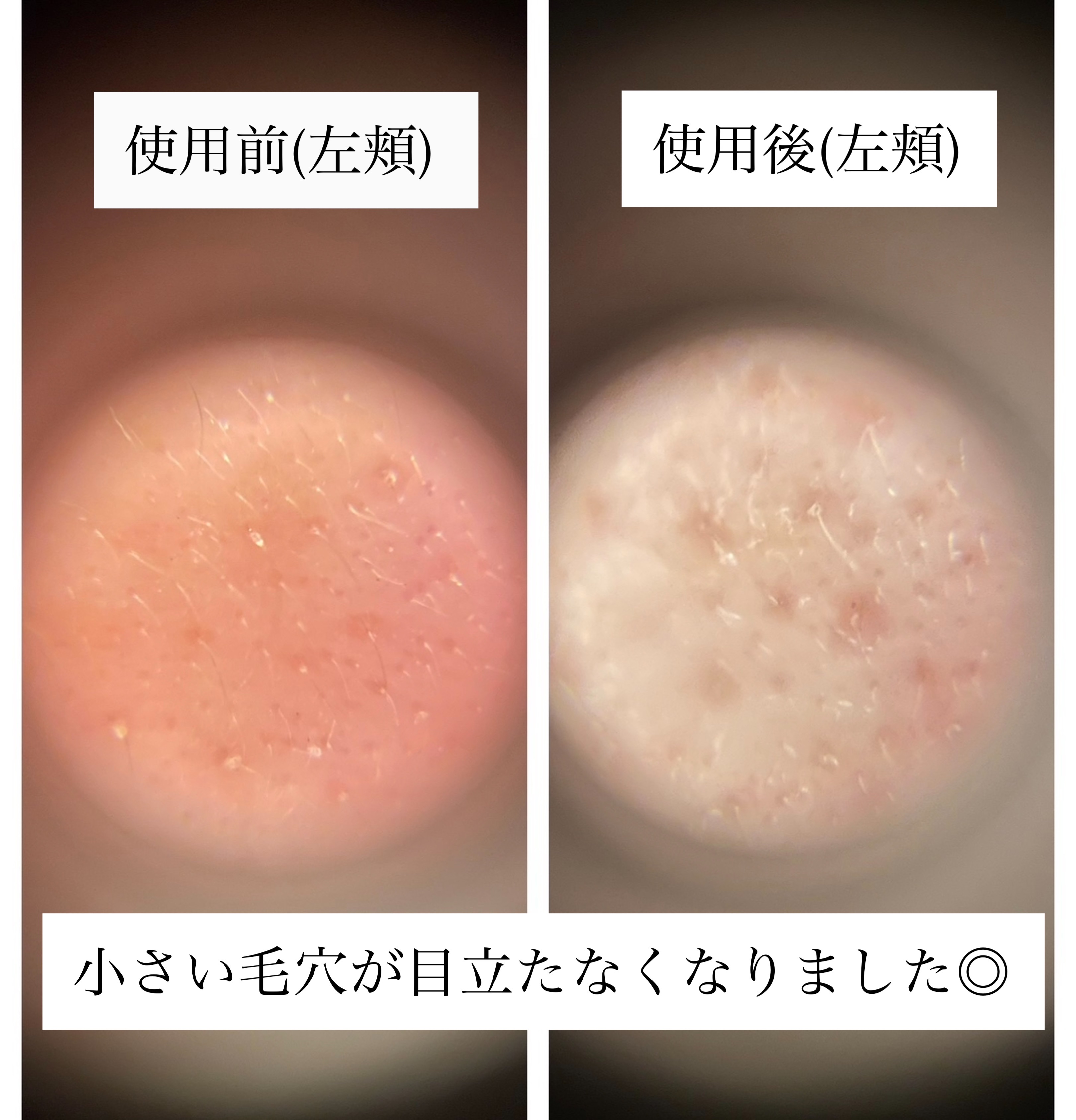 リードルショット100/VT/美容液を使ったクチコミ（3枚目）