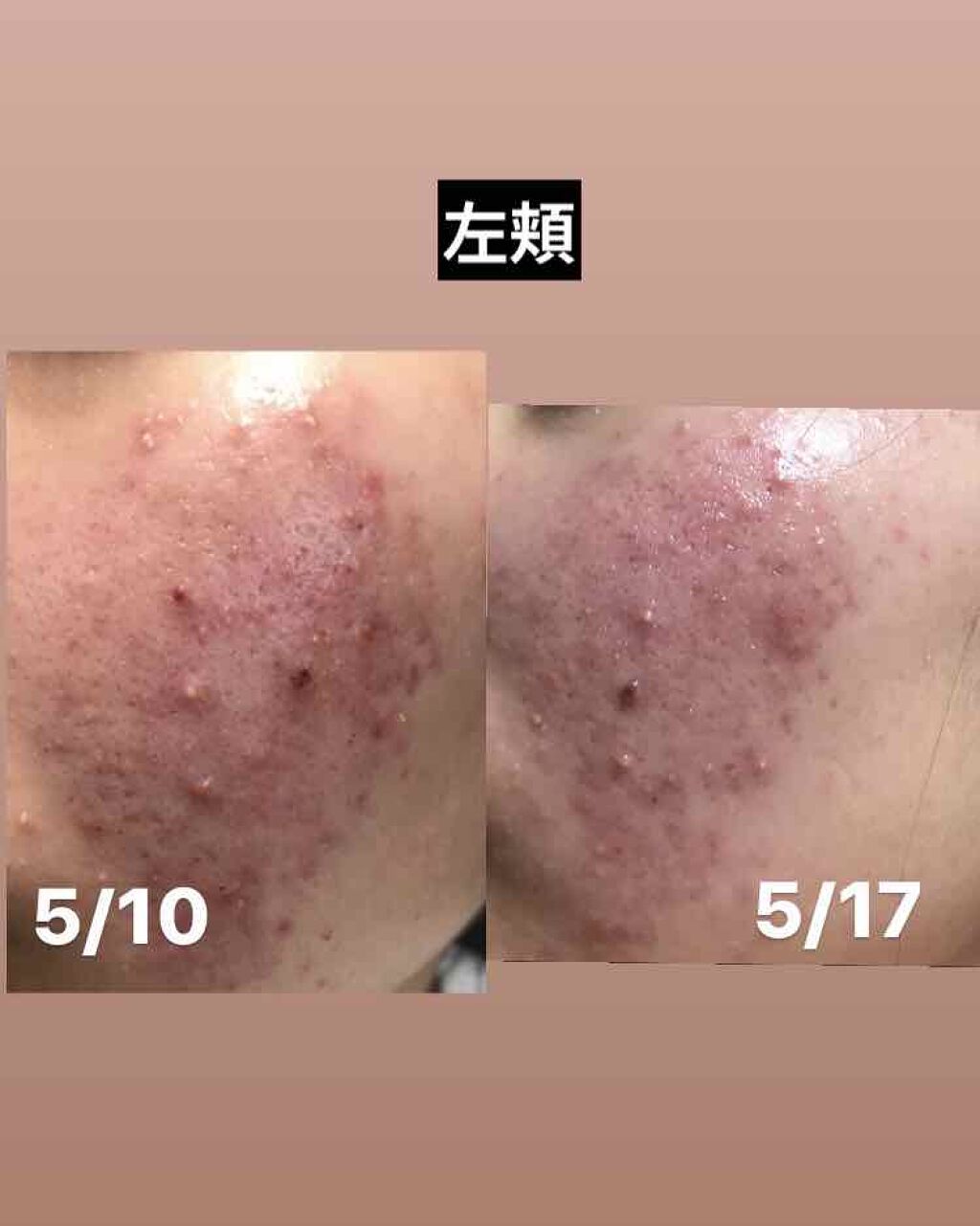 テラ・コートリル 軟膏(医薬品)/ジョンソン・エンド・ジョンソン/その他を使ったクチコミ（2枚目）