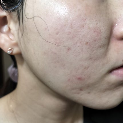 ããã ã®åç²§æ°Ž(ããã¥ãªãš ã¹ãã³ã³ã³ãã£ã·ã§ã㌠R )/ããã¥ãªãš/åç²§æ°Žã䜿ã£ãã¯ãã³ãïŒ1æç®ïŒ