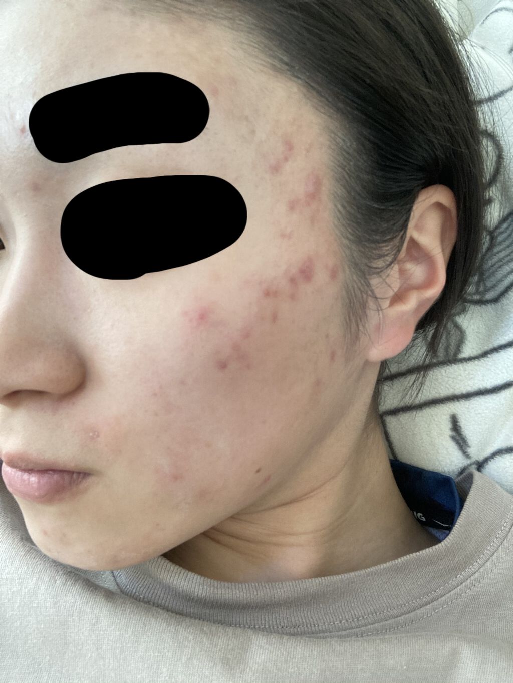 ベピオゲル/マルホ株式会社/その他を使ったクチコミ（2枚目）