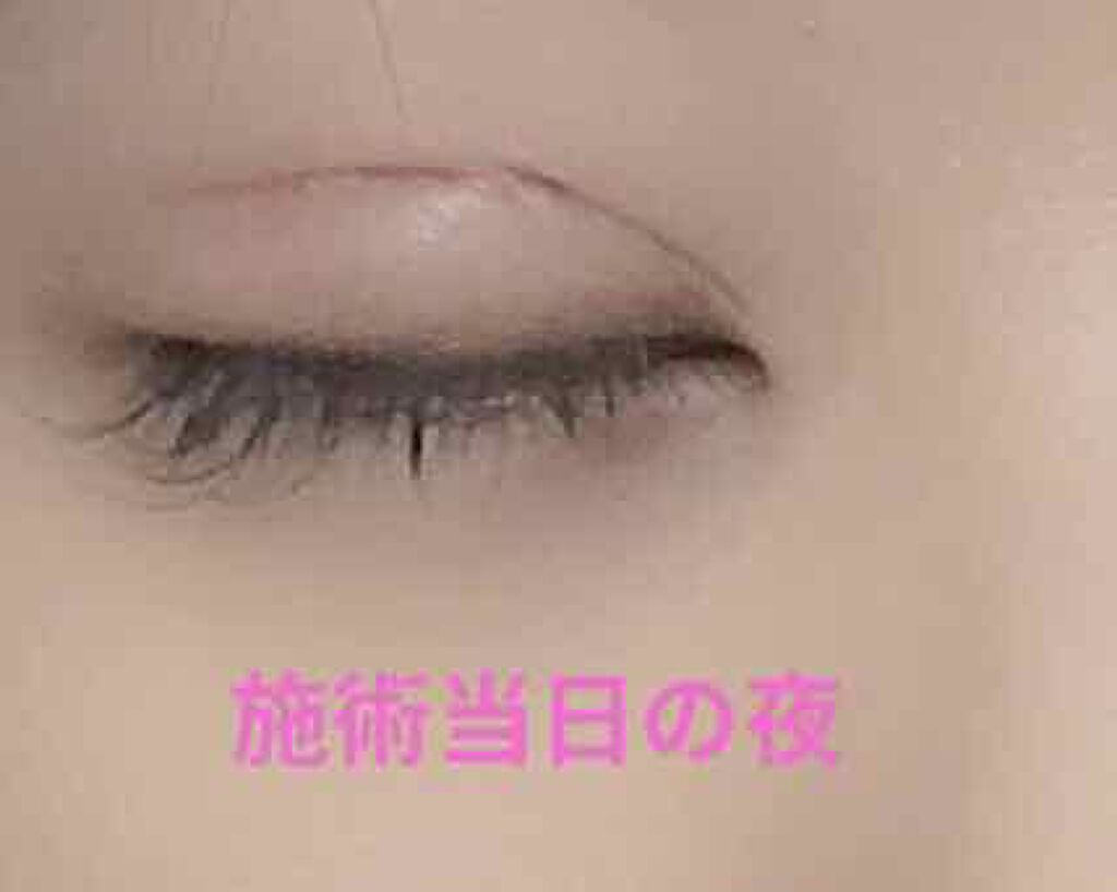 asir on LIPS 「二重整形 埋没(2点留め)10/3整形しました!⚠️写真注意で..」(4枚目)