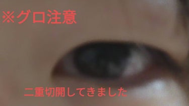 りりな on LIPS 「重い一重から二重切開法で、整形してきました。なので少しレポ書い..」（1枚目）