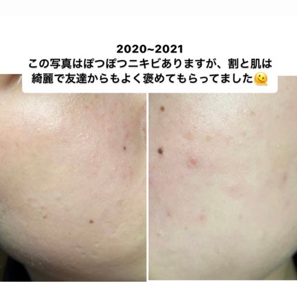 ニキビ治療薬(医薬品)/メンソレータム アクネス/その他を使ったクチコミ(3枚目)