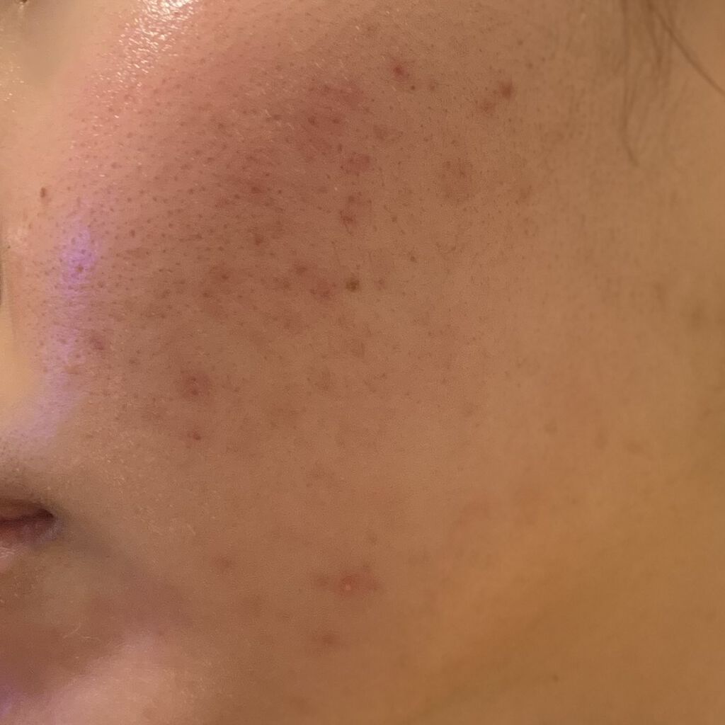 ベピオゲル/マルホ株式会社/その他を使ったクチコミ（1枚目）