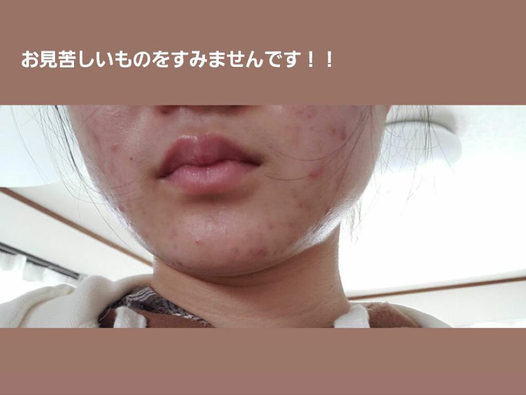 ちぃ on LIPS 「小学校の頃から始まりずっと悩み続けています、、最近はこれでもだ..」(2枚目)
