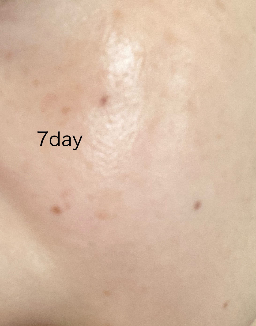 アゼライン酸15 インテンスカーミングセラム/Anua/美容液を使ったクチコミ（3枚目）