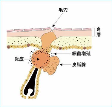 アクネケア エマルジョン R/d プログラム/乳液を使ったクチコミ（2枚目）