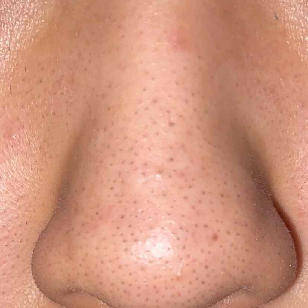 ㎠on LIPS ãð»åæçš¿ã»æ¯ç©Žã®åå ç§ã®å Žåãåç²§ããã¯ãããŠããæ¯ç©Žãã§ããŠ..ãïŒ4æç®ïŒ