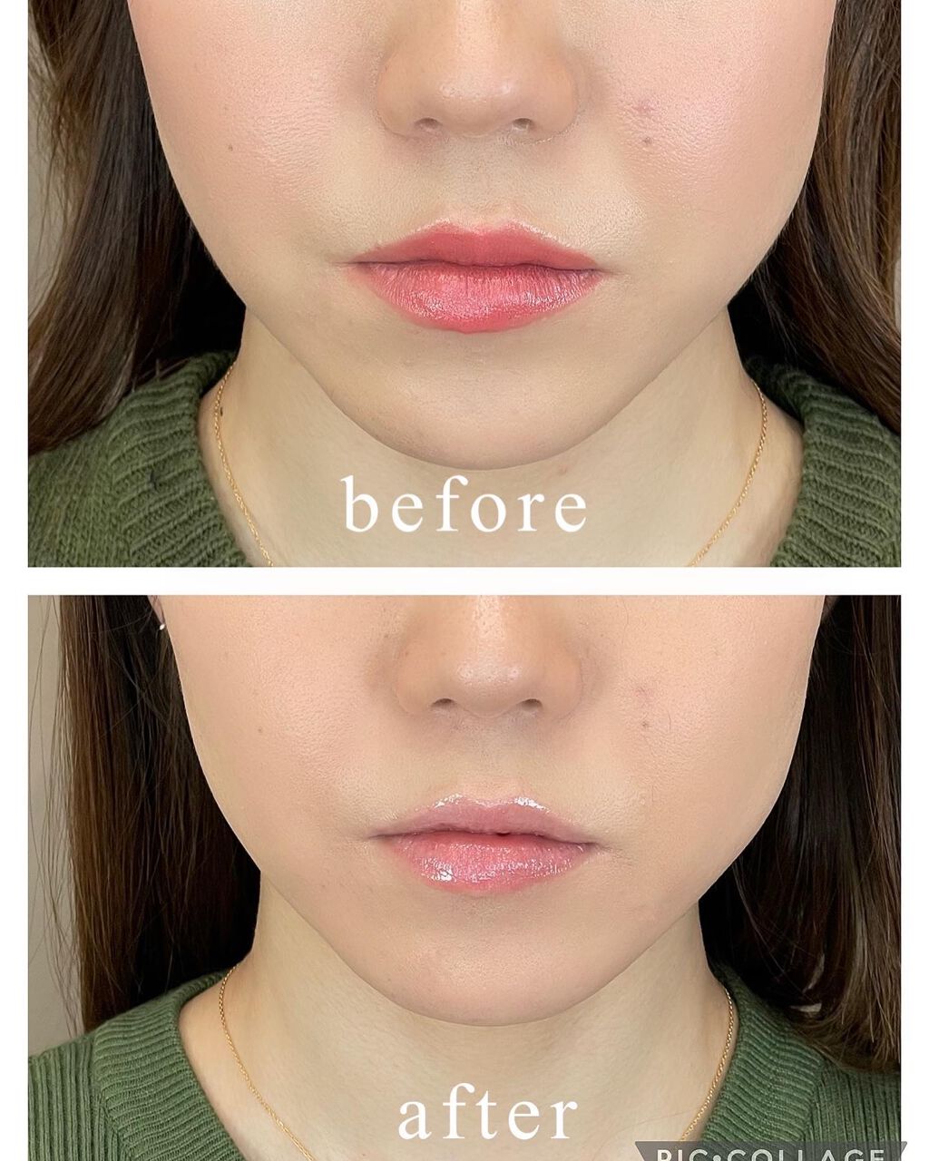 頑張らないりんごさん🍎 on LIPS 「✱ビフォアフ有!東京中央美容外科札幌院 @tcb_sappor..」(2枚目)