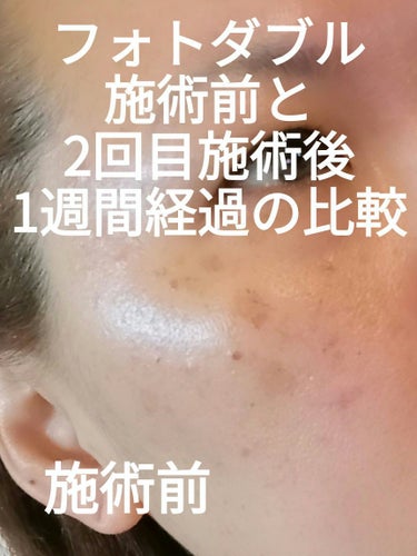 ビヨンセ奥二重向上委員長🥸LIPSパートナー🥳 on LIPS 「フォトダブル施術前、一回目の7日後、2回目の7日後の経過です。..」（1枚目）