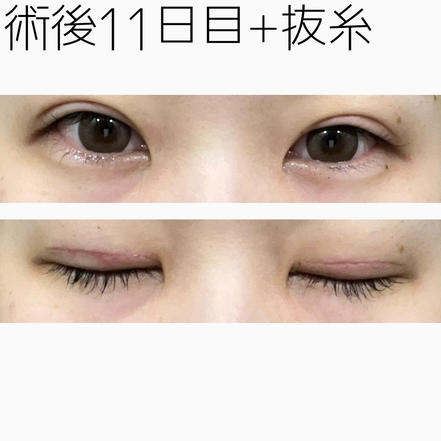 NANO@フォロバ! on LIPS 「二重整形ダウンタイム記録/抜糸してきました!ぴょんぴょん出てい..」(2枚目)