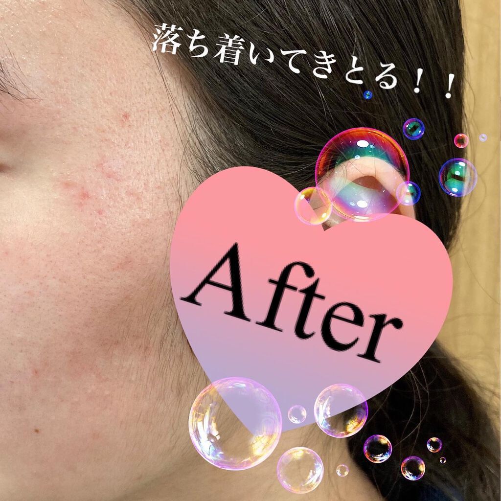 ドクダミ 77 スージングトナー/Anua/化粧水を使ったクチコミ(10枚目)