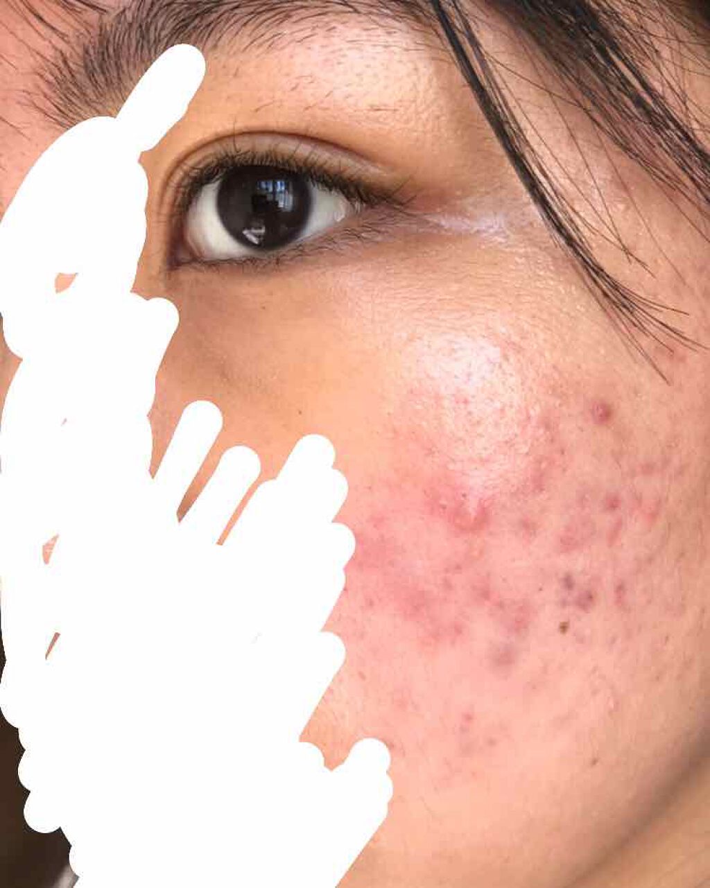 にき子 on LIPS 「【ニキビ治療記録】なおらないつかれたー!とりあえず写真だけ載せ..」(1枚目)