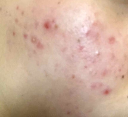 オードムーゲ 薬用ローション(ふきとり化粧水)/オードムーゲ/拭き取り化粧水を使ったクチコミ(2枚目)