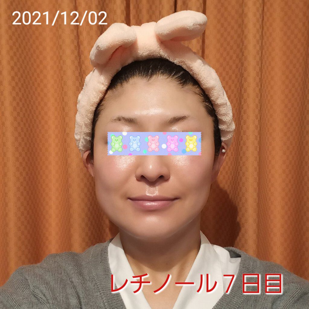 トレチノインジェル/A-Ret/美容液を使ったクチコミ（1枚目）