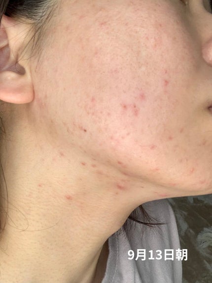 薬用 しみ 集中対策 美容液/メラノCC/美容液を使ったクチコミ(10枚目)