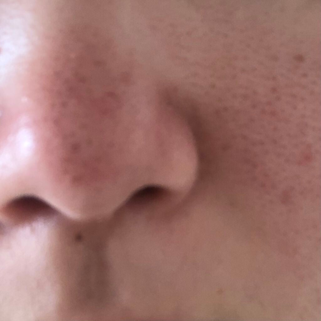 Shurn______% on LIPS 「毛穴ってどうすれば治りますか?開き毛穴すぎて改善策がみあたりま..」(2枚目)