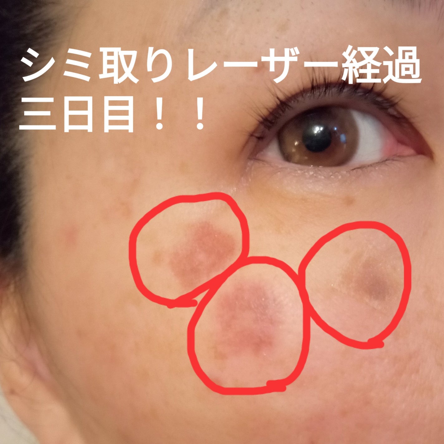 ビヨンセ奥二重向上委員長🥸LIPSパートナー🥳 on LIPS 「シミ取りレーザー経過三日目です!まだ照射部分は赤みがあり、若干..」(1枚目)