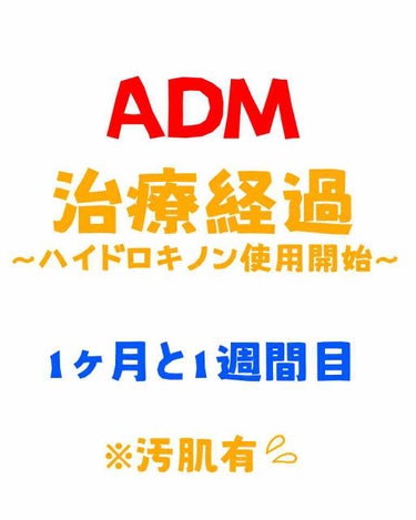 
【ADM治療経過〜ハイドロキノン使用開始〜】
1ヶ月と1週間


さてさて、前回の投稿から1週間経ちました。

前回の投稿ではレーザー治療から1ヶ月経ったので、#ハイドロキノン　を使用しますというお知