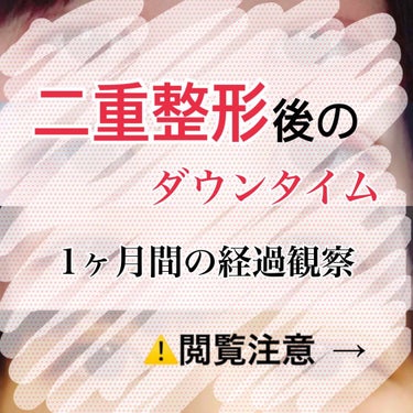 ゆず汰 on LIPS 「二重整形（埋没法）から1ヶ月以上経ちました！ダウンタイムの様子..」（1枚目）