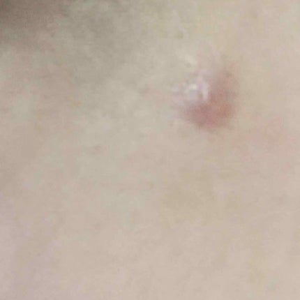 薬用 しみ 集中対策 美容液/メラノCC/美容液を使ったクチコミ(2枚目)