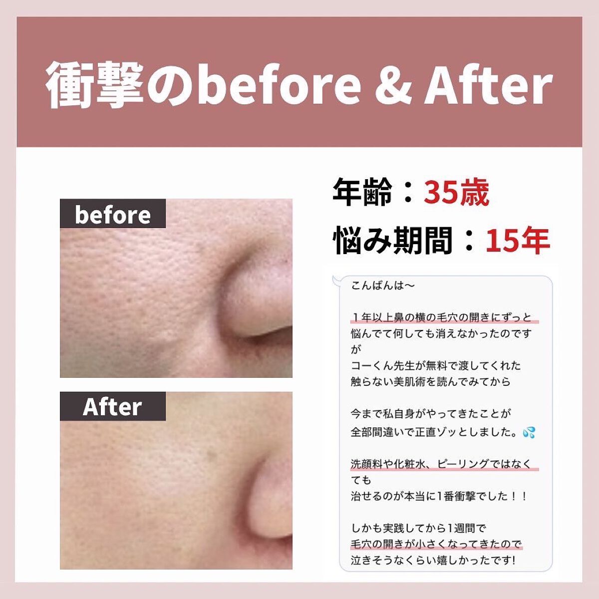 あなたの肌に合ったスキンケア💐コーくん先生 on LIPS 「【4月までに毛穴の開きをなくしたい人だけ見てください。】.
...」(4枚目)