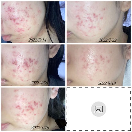 レチノールA 1% アドバンスドリバイタリゼーションクリーム/Life-flo/フェイスクリームを使ったクチコミ(3枚目)