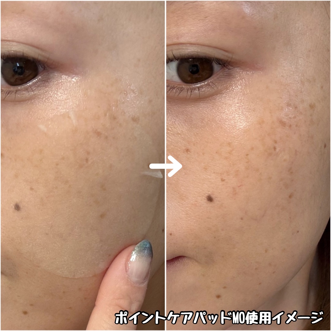オーマイイージー デイリーポイントケアパッド MO　/ウテナ/トナーパッドを使ったクチコミ（3枚目）