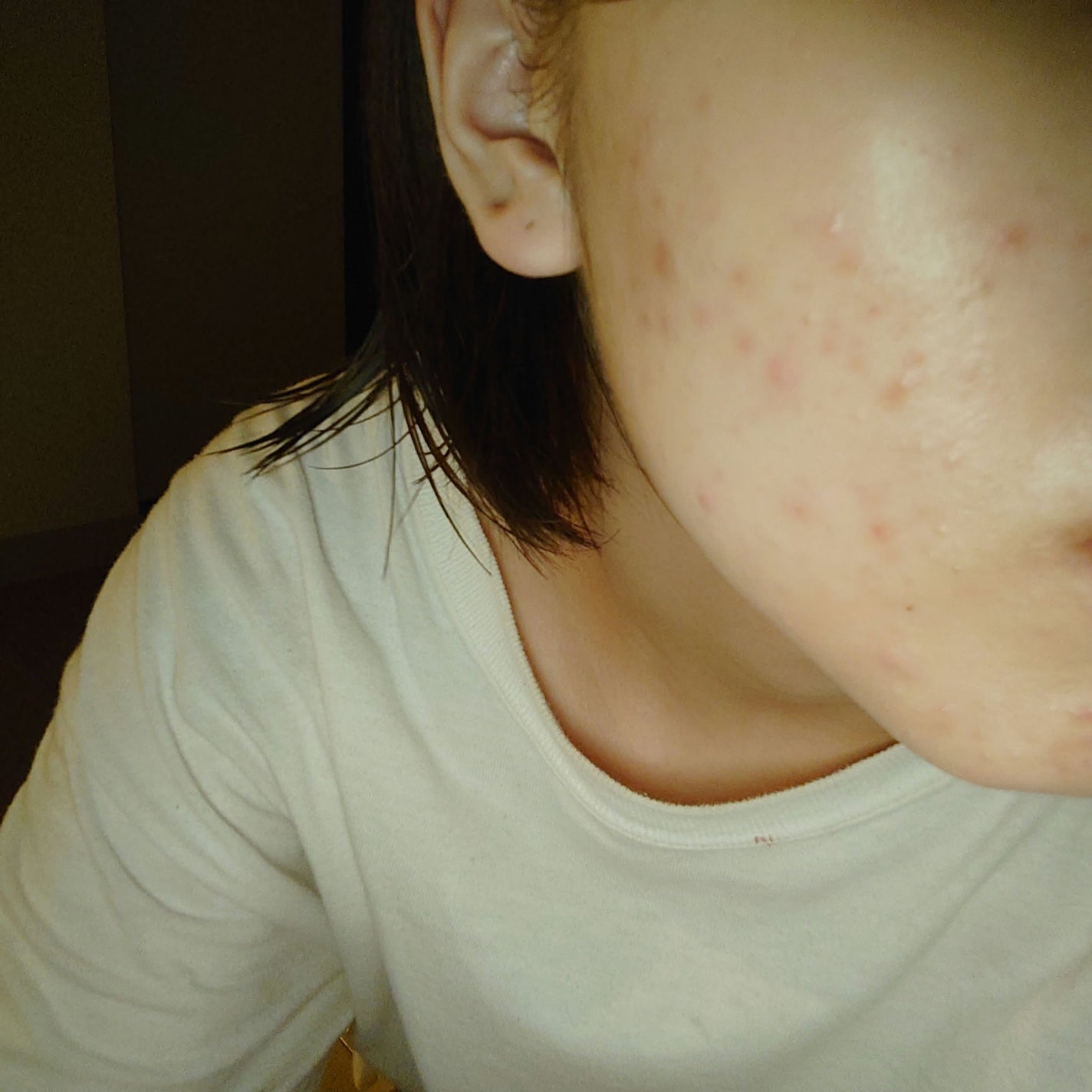 twinkle_blush_la9b on LIPS 「このプツプツの改善方法教えてください😭😭😭結構色々試してますか..」(1枚目)