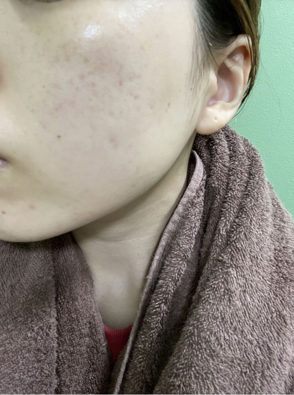 AHA 30% + BHA 2% Peeling Solution/The Ordinary/ピーリングを使ったクチコミ（3枚目）