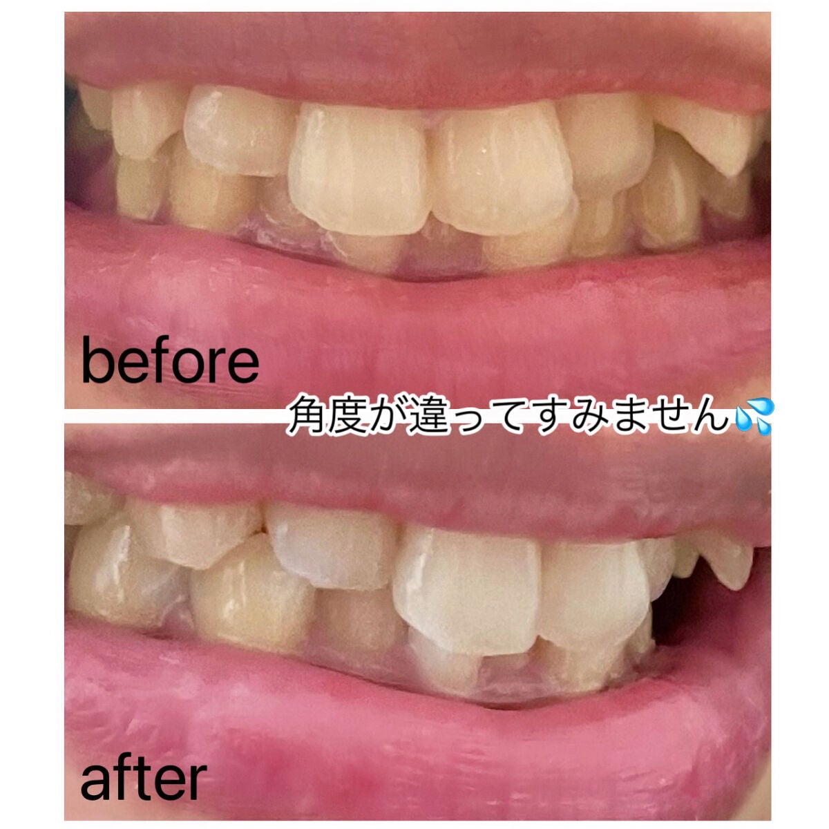 プレミアム ティースホワイトパック/Smile Cosmetique/その他オーラルケアを使ったクチコミ(3枚目)