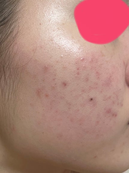 によよよん on LIPS 「ニキビ経過観察7日目✂ーーーーーーーーーーーーーーーーーーーー..」(1枚目)