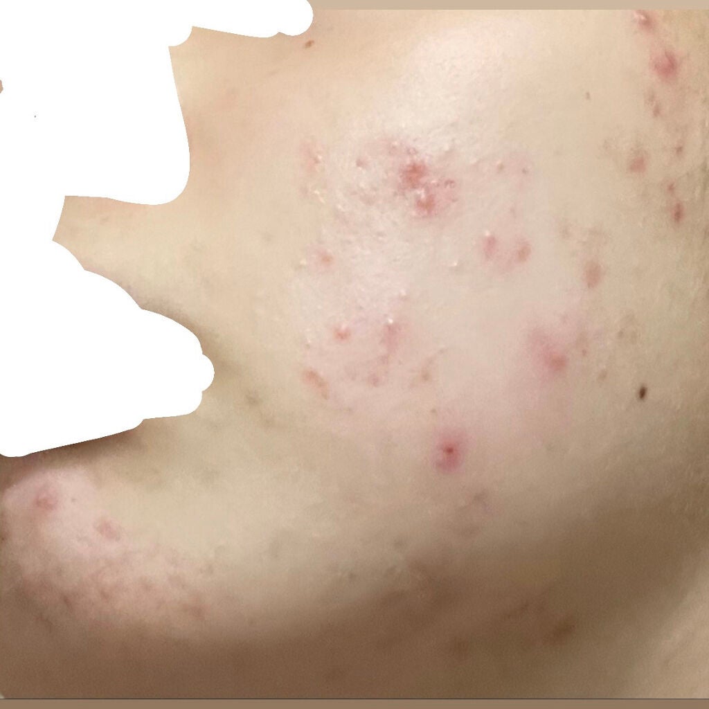 orange_beauty_6q68 on LIPS 「治癒の過程です。写真の向きが違いますが同じ側の頬です。治ってき..」(3枚目)