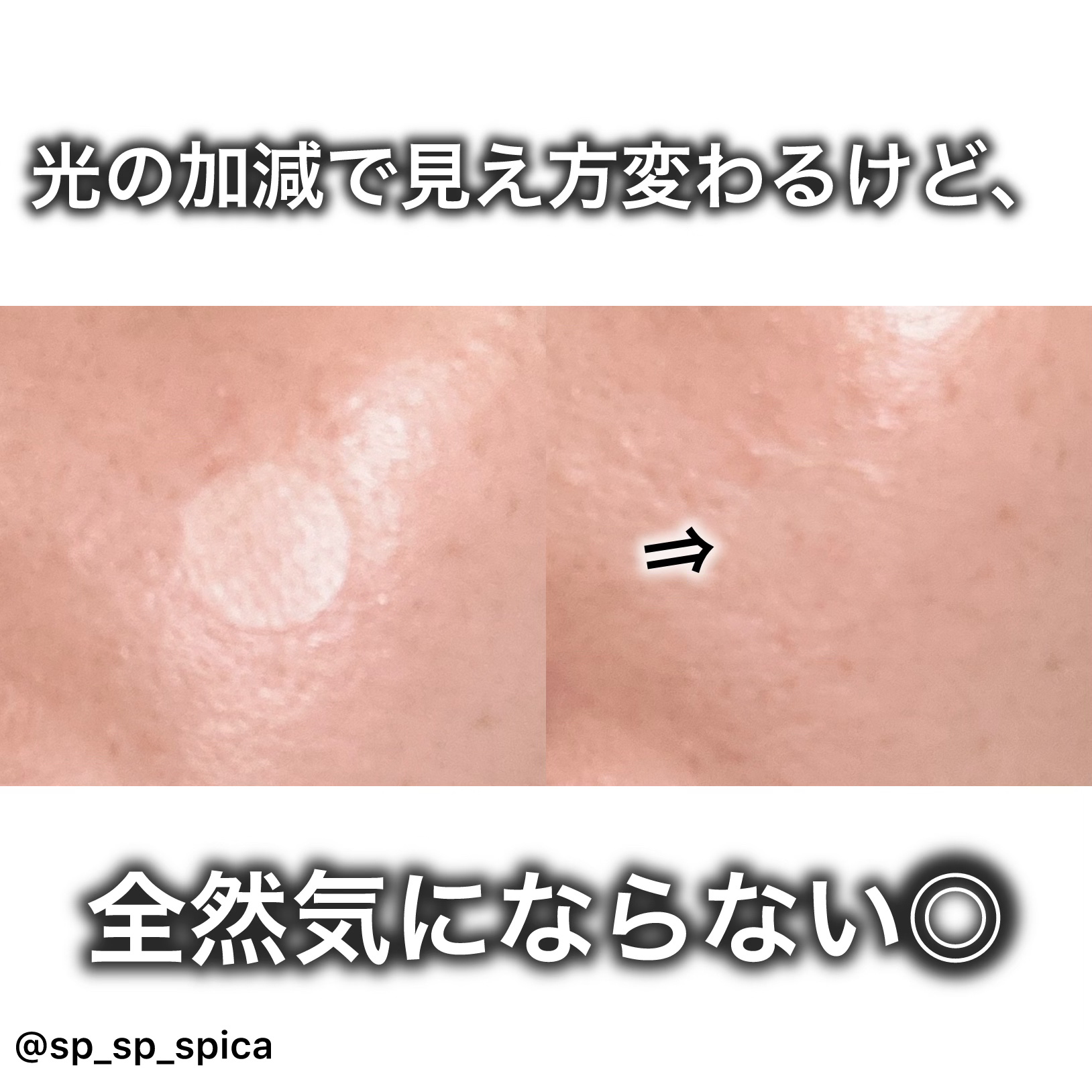 SPOT PATCH ロールタイプ/Shupong/にきびパッチを使ったクチコミ（3枚目）